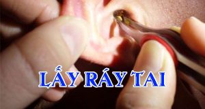 Ráy tai là gì? Lấy ráy tai như nào mới an toàn? 3 lay ray tai