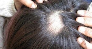Trị hói đầu ở nữ giới bằng cách nào để lấy lại sự tự tin  1 Trị hói đầu ở nữ giới là vấn đề khiến chị em quan tâm