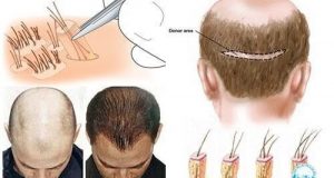 Trị hói đầu ở nam giới hiệu quả ngay từ lần đầu  2 Các bạn nam giới sẽ trở nên tự tin hơn khi không còn bị hói đầu