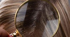 17 cách trị gàu hiệu quả 1 13 cach loai bo gau hieu qua